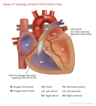 tetralogy of fallot exterior heart illustration