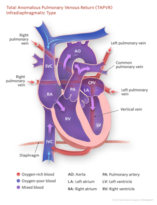 total anomalous pulmonary venous return infradiaphragmatic type illustration
