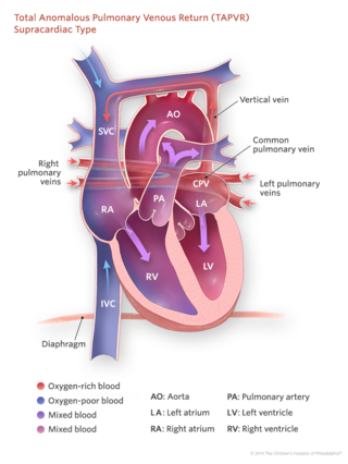 total anomalous pulmonary venous return supracardiac type heart illustration