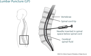 Lumbar Puncture Image