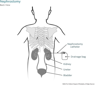 Nephrostomy Back View Image