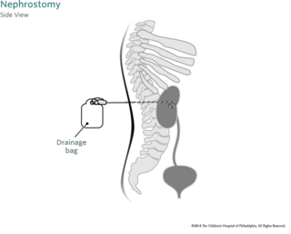Nephrostomy Tube Side View Image