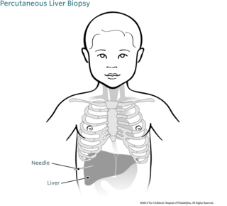 Percutaneous Liver Biopsy Image