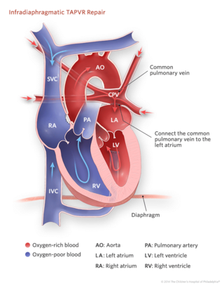 Infradiaphragmatic Total Anomalous Pulmonary Venous Return Repair Illustration