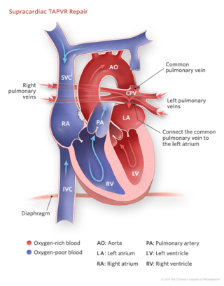 Supradiaphragmatic Total Anomalous Pulmonary Venous Return Repair Illustration