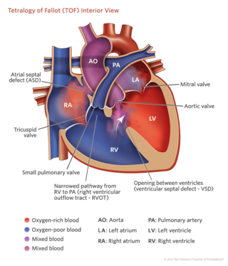 tetralogy of fallot interior heart illustration