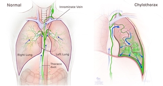 Chylothorax anatomical illustration