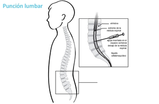 Punción lumbar
