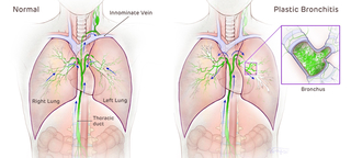 anatomical illustration normal pulmonary system vs plastic bronchitis pulmonary system