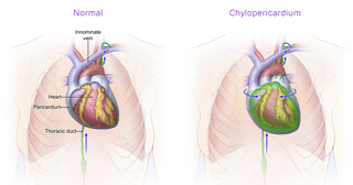 Chylopericardium medical illustration