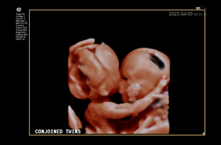 Ruffin Twins Photo
