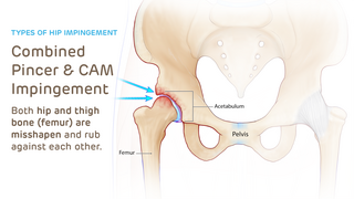 CAM Pincer exterior