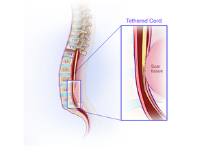 The reason for tethering is scar tissue, often from prior surgery. Forming scar tissue is the body's natural healing response and usually cannot be avoided.