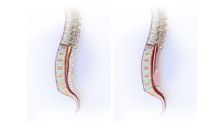 Normal spinal column compared to spinal column with tethered spinal cord.