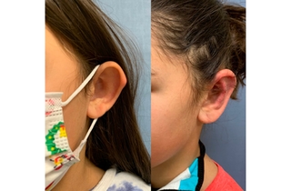 Ear surgery - before and after