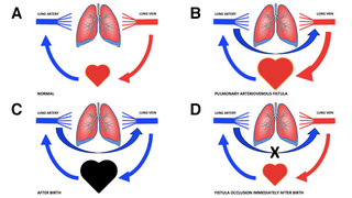Sequence of diagrams demonstrating the physiology of PAVF and our treatment strategy.