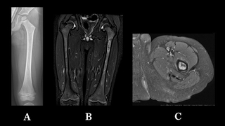 B.D.'s leg X-rays