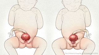 Illustration of female and male babies with exposed bladder caused by bladder exstrophy.