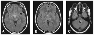 brain mri
