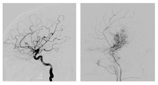 brain vascularization images