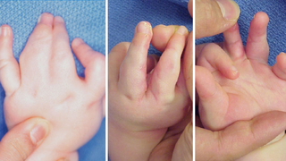 Complete Syndactyly