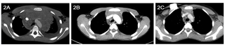 ct scan before and after chemotherapy