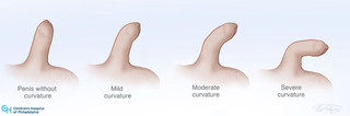 curved penis