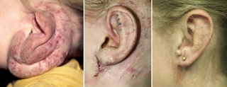 Ear Hemangioma in infancy