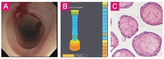 Endoscopy vs. FLIP images
