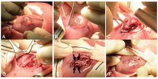 fetal mmc disclosure