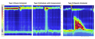 high-res esophageal manometry image