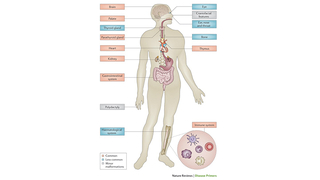 Illustration of 22q11.2 deletion syndrome
