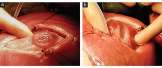 Intraoperative photographs of myelomeningocele (MMC) and myeloschisis (MS) 