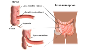 intussusception illustration