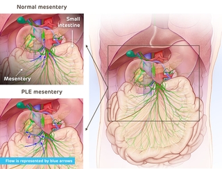 Diagram Protein-Losing Enteropathy Liver 