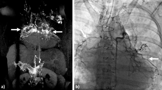 Magnetic Resonance Lymphangiography