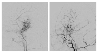 moyamoya post-surgery angiogram