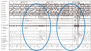 patient oropharynx and overnight polysomnogram