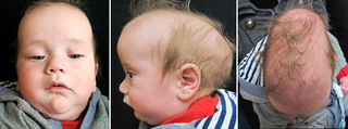 Sagittal Synostosis
