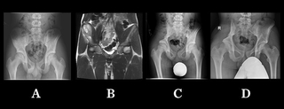 x-ray of right ilium