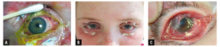 stevens johnson syndrome photos