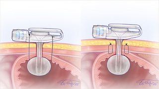 Two methods for attaching the stomach to the abdominal wall