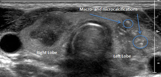two large hypoechoic nodules