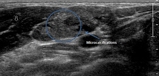 abnormal lymph node