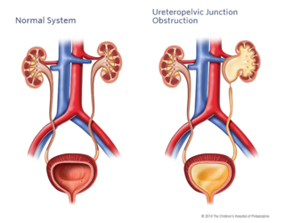Ureteropelvic Junction Illustration