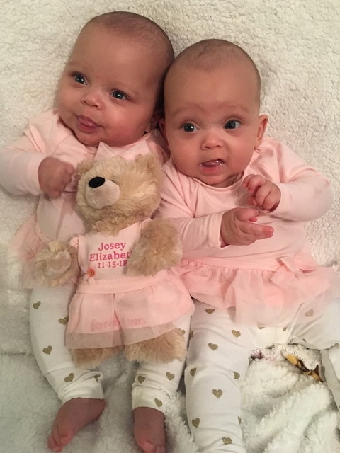 After the twins were born, Audrey (left) developed an enlarged tongue, a symptom of Beckwith-Wiedemann syndrome.