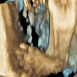 3-D ultrasounds of clubfoot 3-D ultrasounds of clubfoot