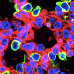CRISPR-edited lung cells (green) with fluorescent protein. Many, but not all, are alveolar lung cells. CRISPR-edited lung cells