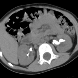 CT of patient