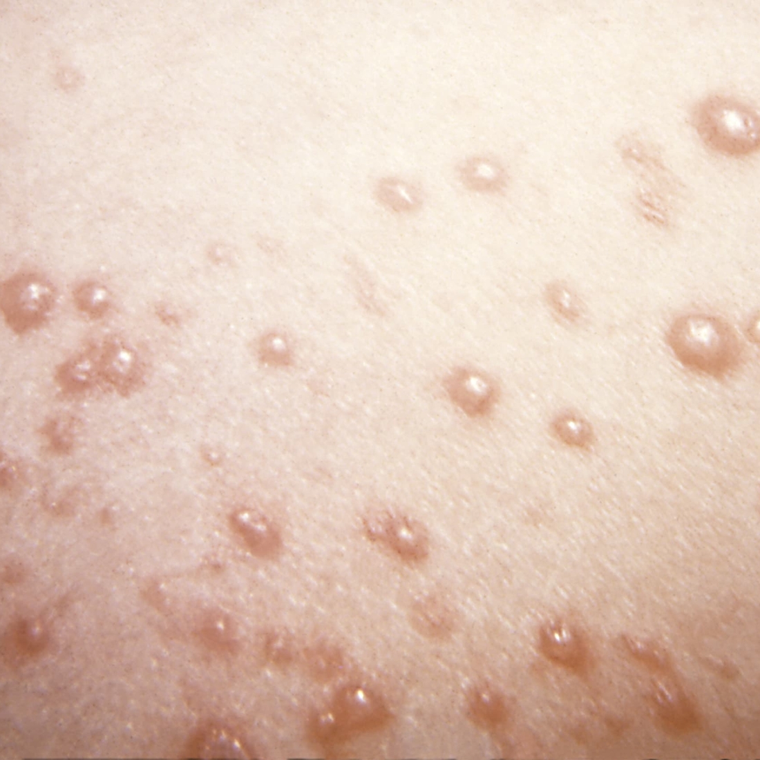 Rash Information | Children's Hospital of Philadelphia